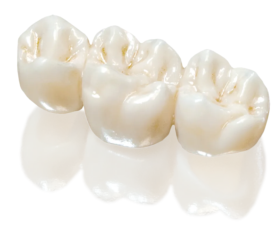 Example of an all-ceramic dental bridge