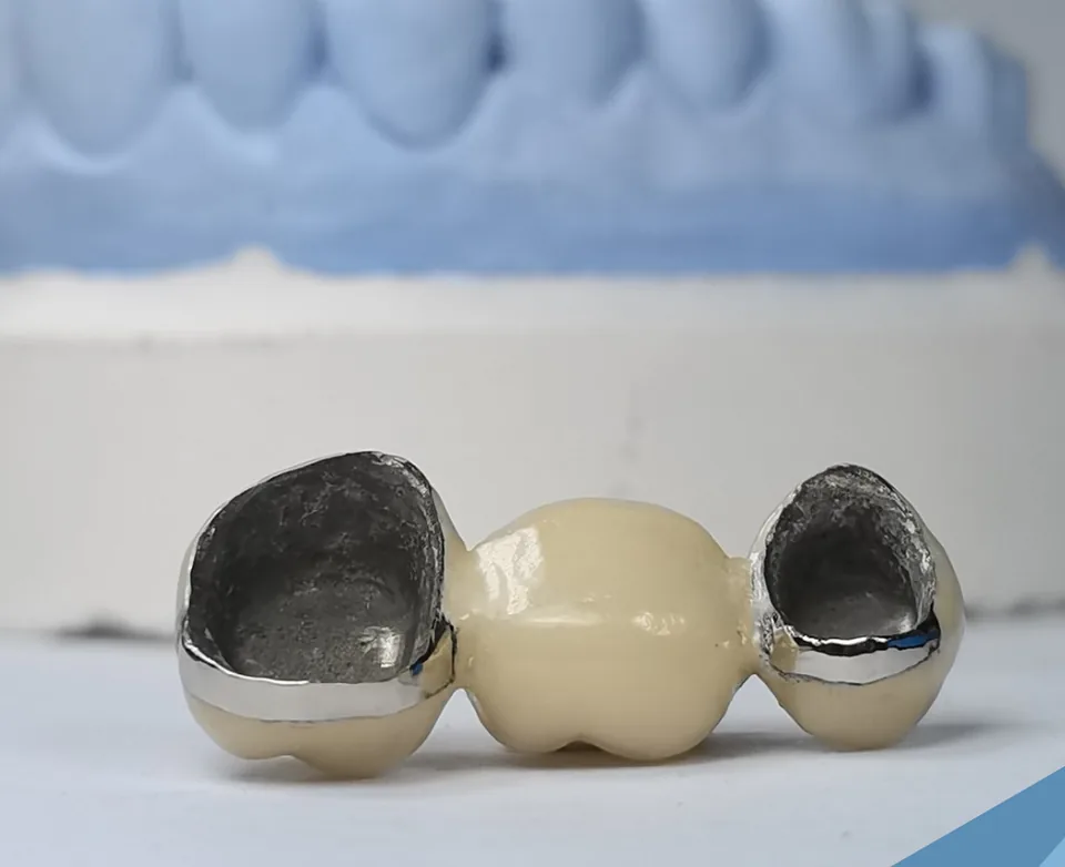 Example of a metal-ceramic dental bridge