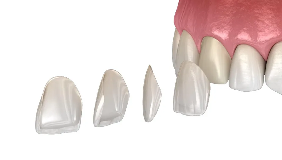 Illustration of thin veneers fitted over the front surfaces of teeth